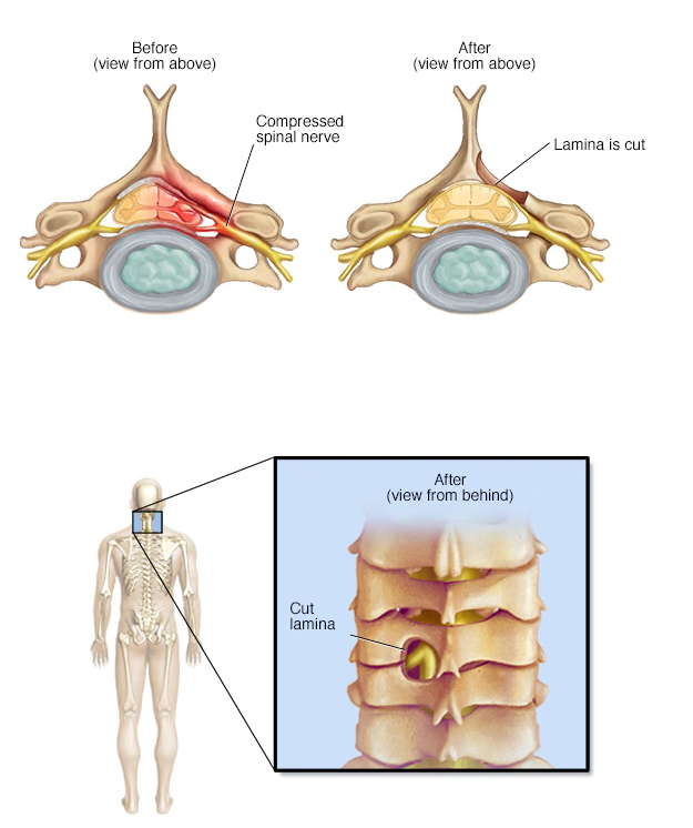 لامینکتومی2