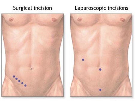 آپاندکتومی4