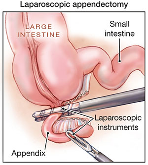 آپاندکتومی 5