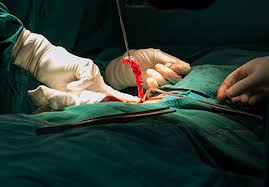 آپاندکتومی 6