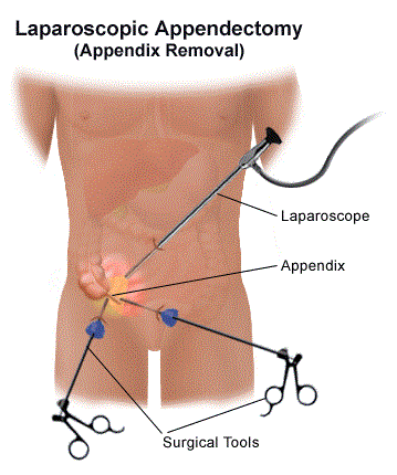 آپاندکتومی1