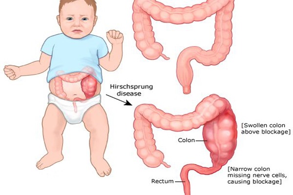 انسداد روده 7