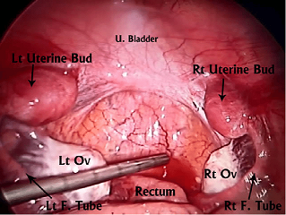لاپاروسکوپی تشخیصی2