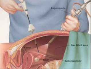 لاپاروسکوپی تشخیصی3