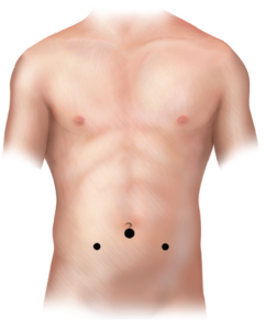 لاپاروسکوپی تشخیصی5