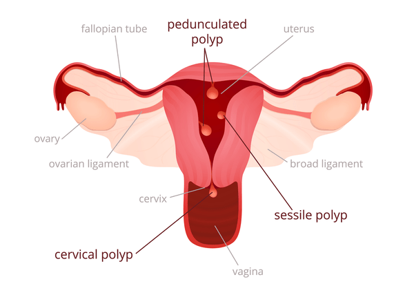پولیپکتومی