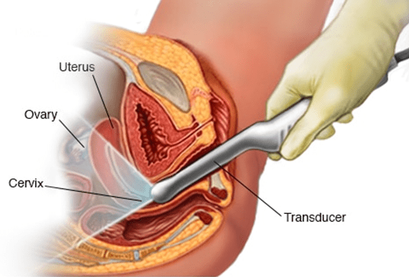 پولیپکتومی1