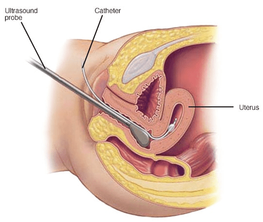 پولیپکتومی2