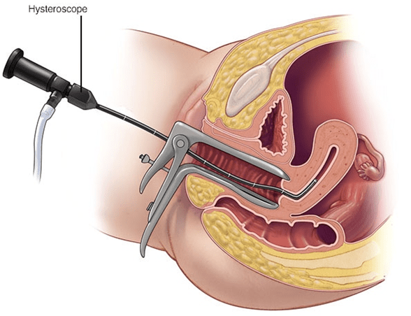 پولیپکتومی3