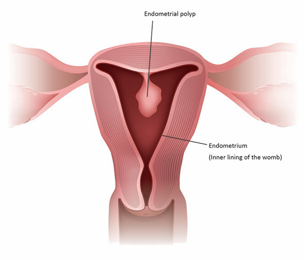 هیستروسکوپی تشخیصی