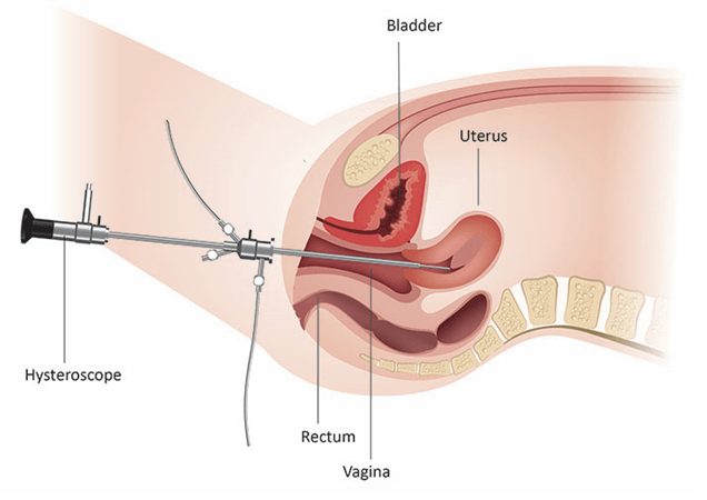 هیستروسکوپی تشخیصی3