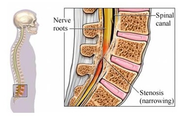 decompressive surgery
