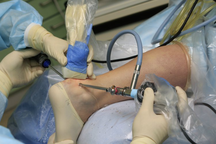 آرتروسکوپی1