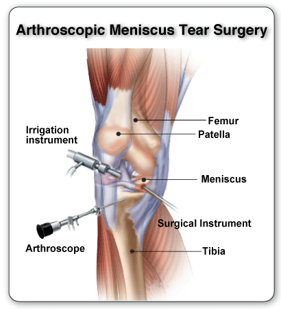 آرتروسکوپی5