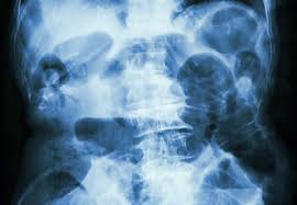 انسداد روده 3